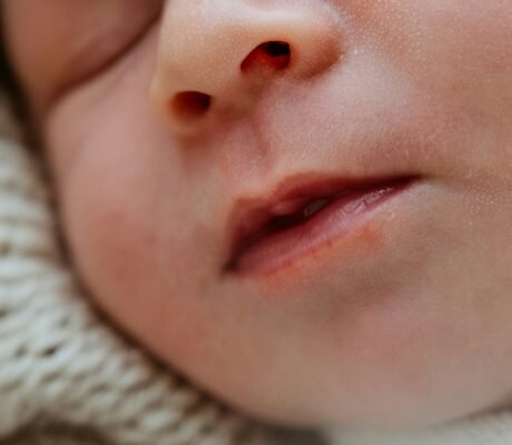 milk blisters on newborn lips